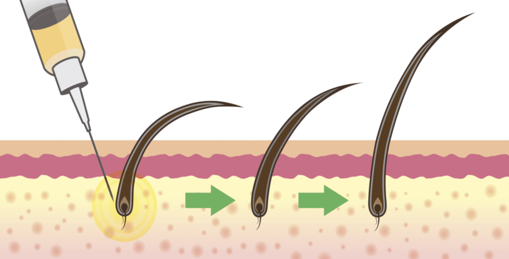 Aesthetica stem cell hair restoration illustrated