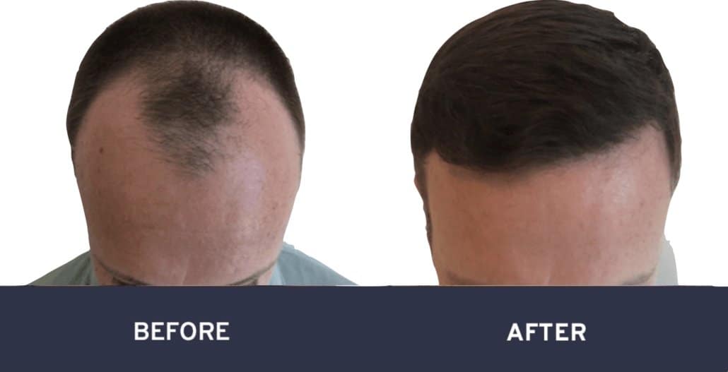 before-after-15 before and after hair transplant photo