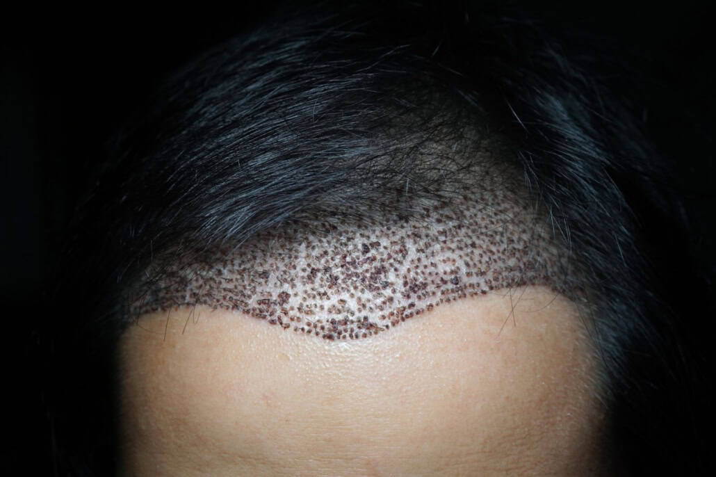 Hair transplant recovery: newly transplanted hairline healing in the days after FUE surgery